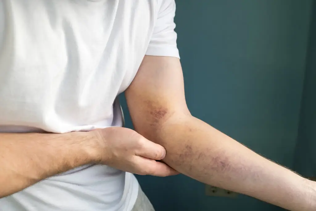 adult man with bruise on arm